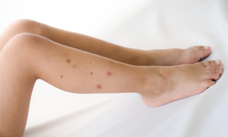 Bed-bugs-cause-itchy-bites-and-skin-irritation